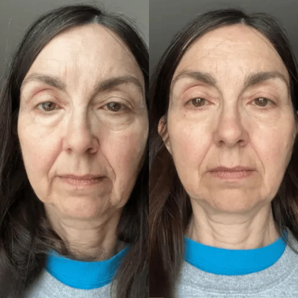 Antes e depois — Kim C.