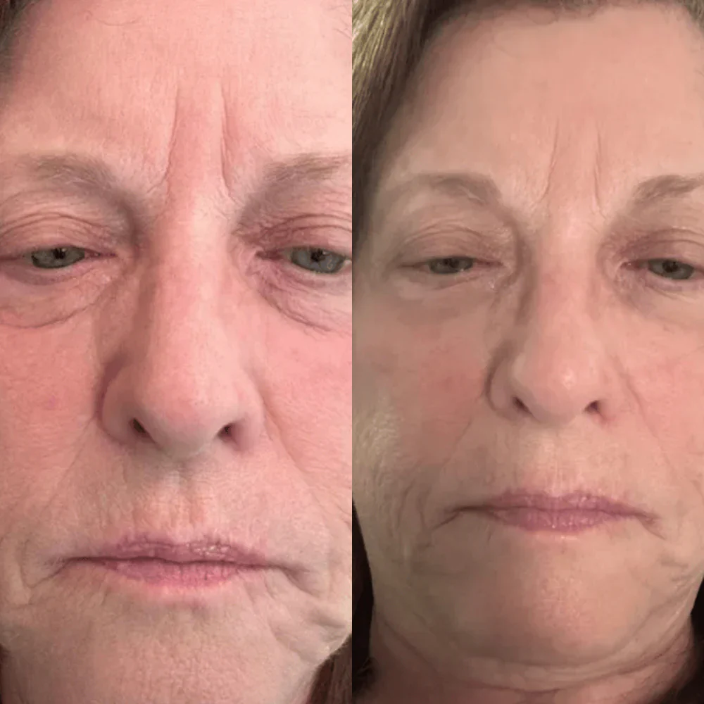Antes e depois — Marina D.