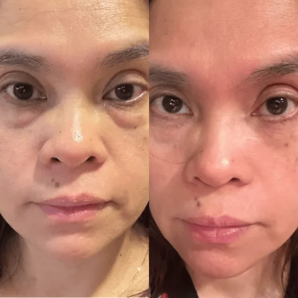 Antes e depois — Leire M.