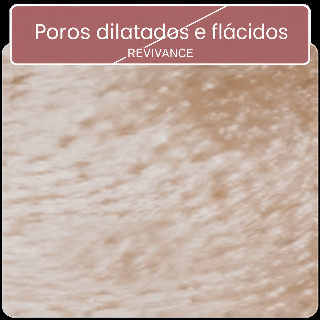 Poros dilatados e flácidos — Revivance