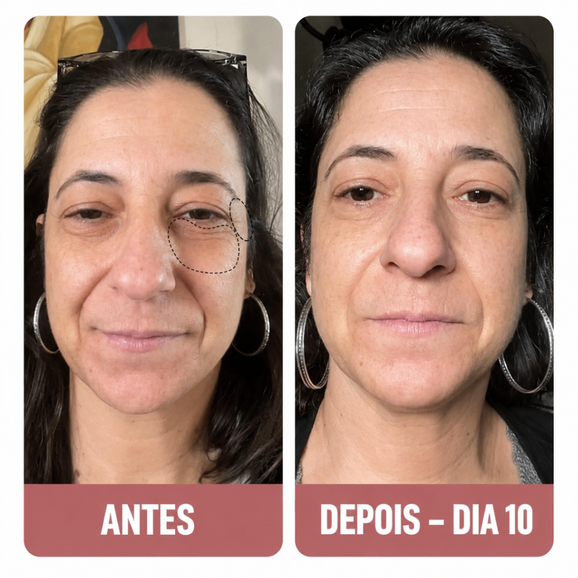 Sílvia A. — avant et après contour des yeux en 10 jours