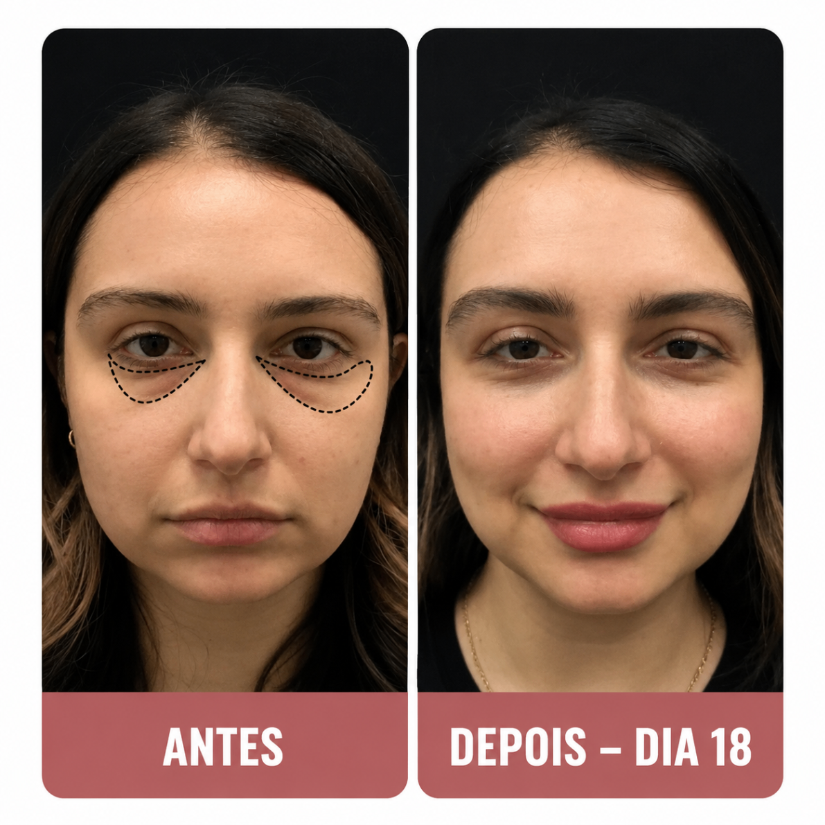 Emma — avant et après contour des yeux en 18 jours