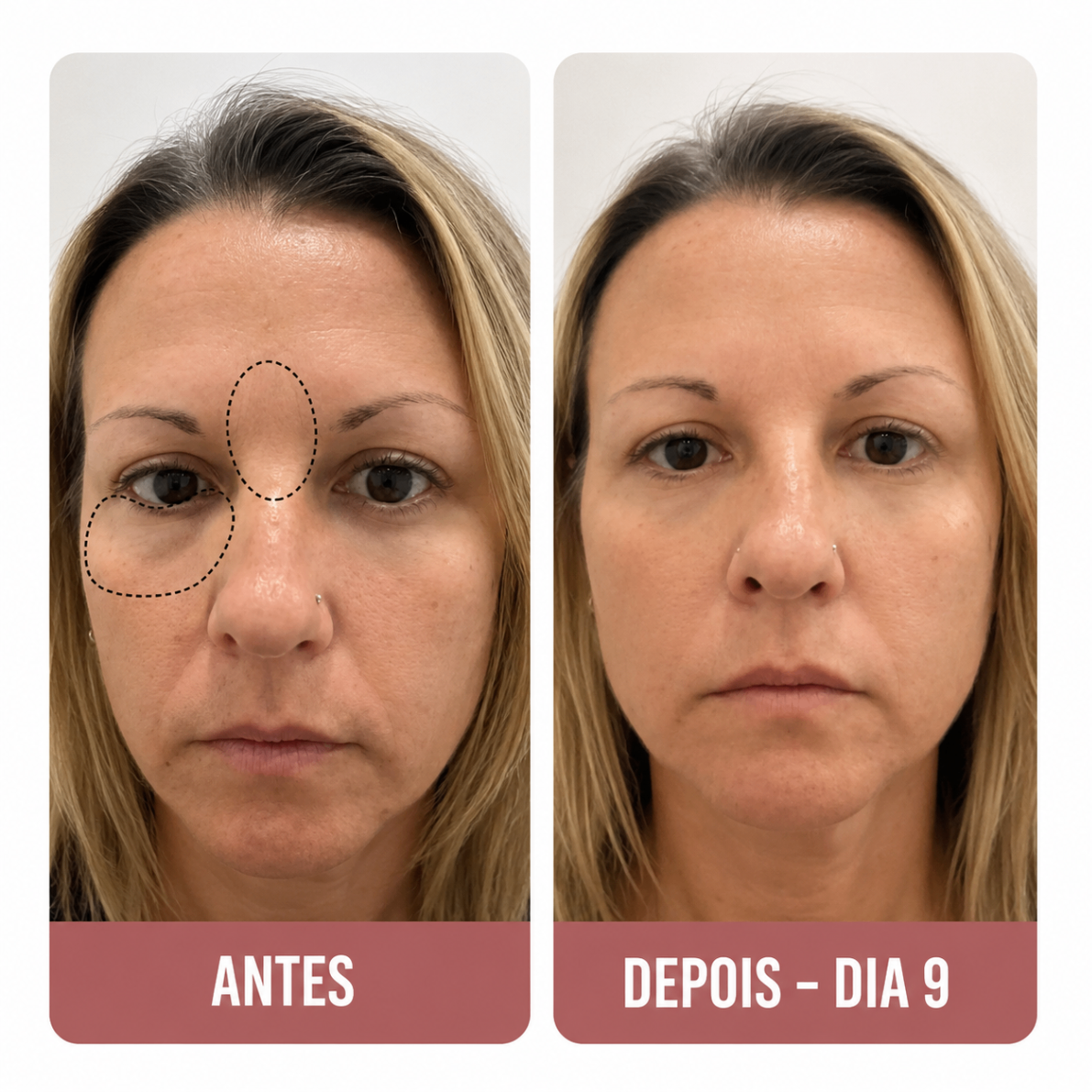 Cláudia R. — avant et après contour des yeux en 9 jours