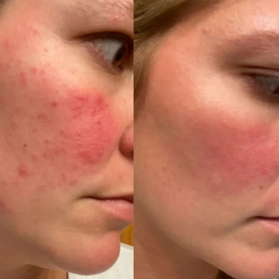 Antes e depois — pele acalmada após uso da Máscara Facial de Colagénio Revivance